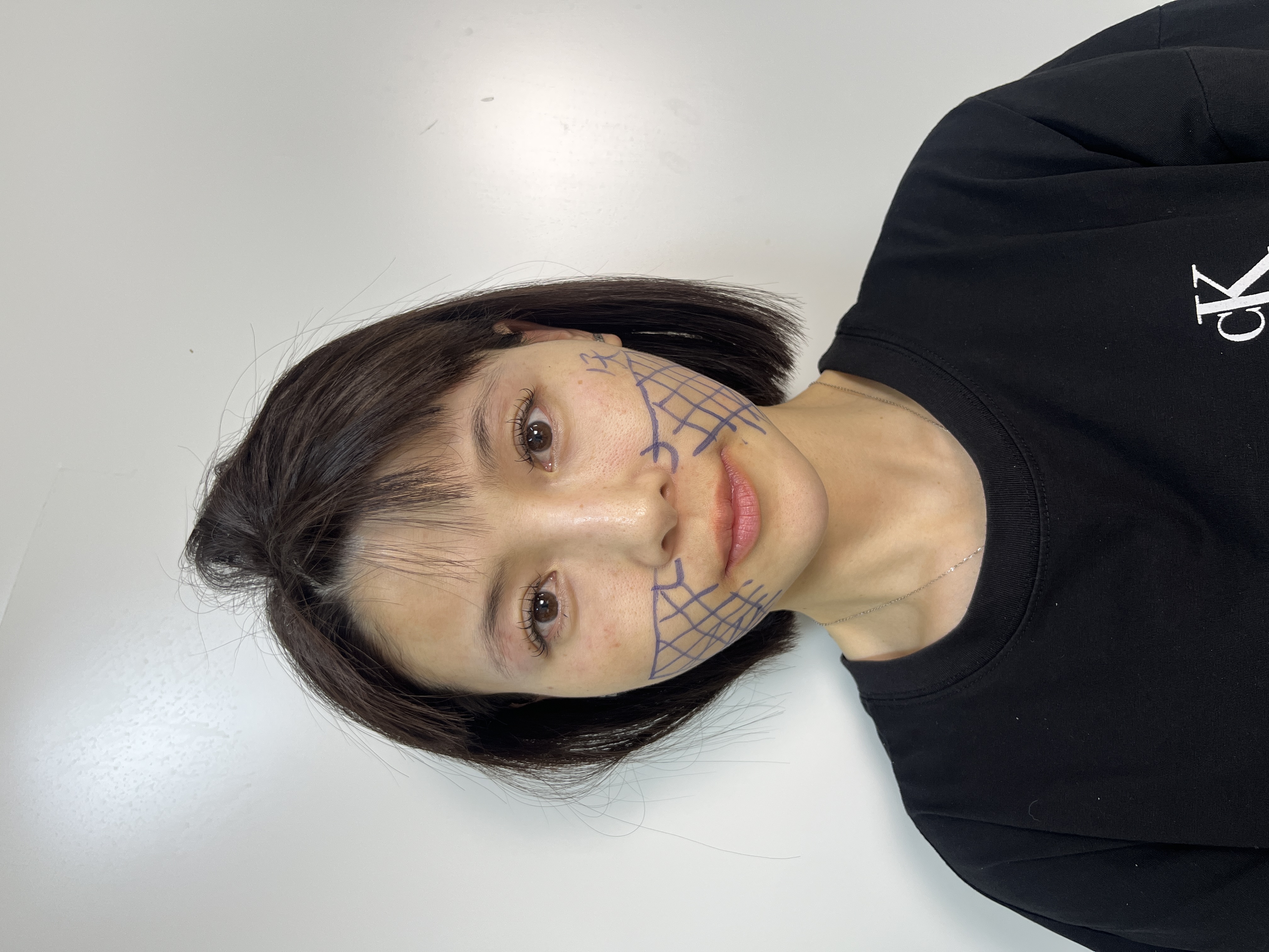 术前画线设计沟通
