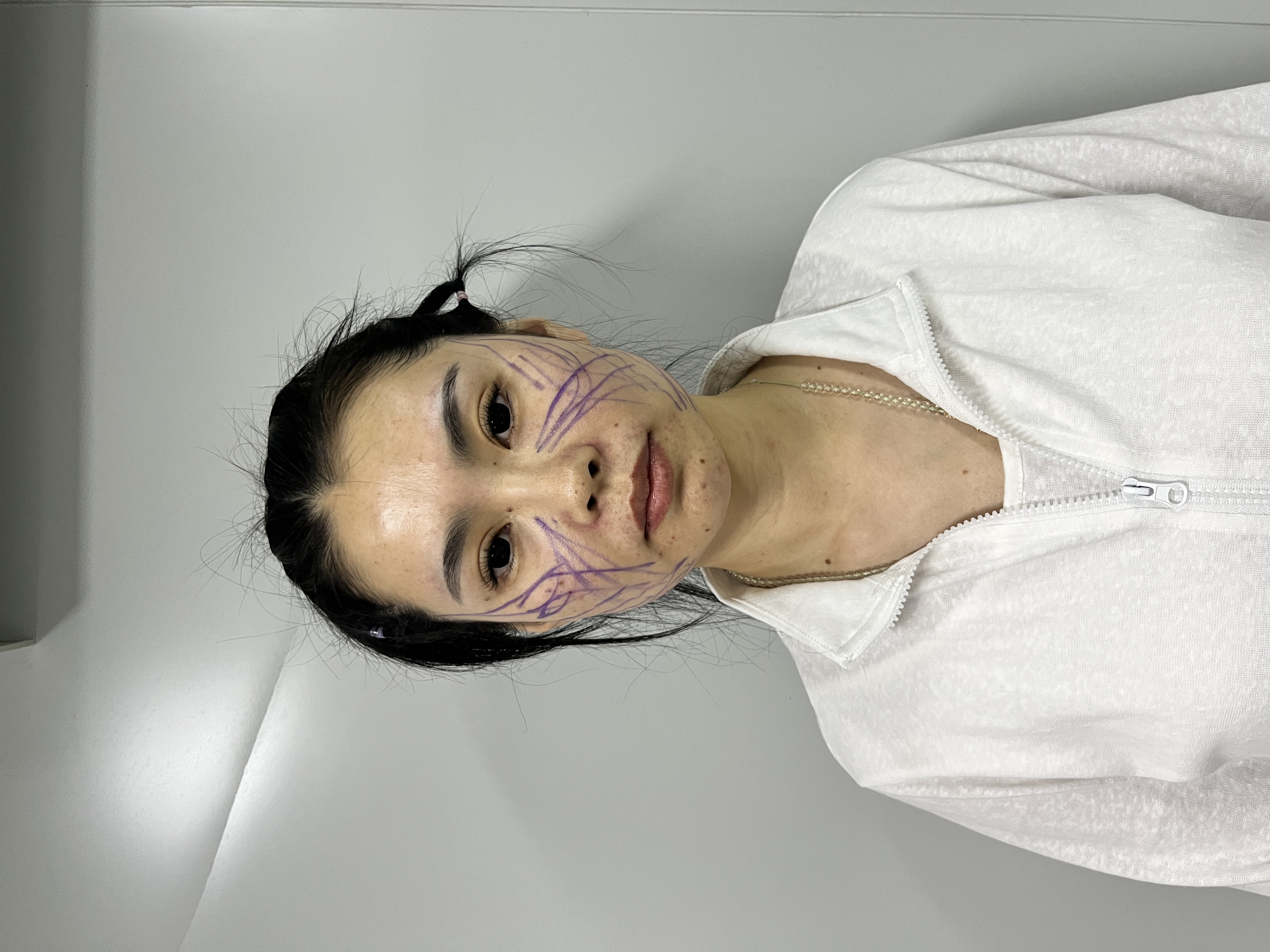 术前画线设计沟通